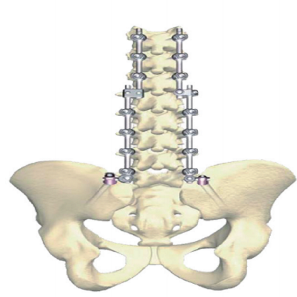 VIV 6.0 Sacroiliac Screw - Image 4