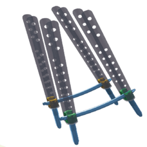 TINY 5.5 Minimally Invasive Screw-Rod Internal Fixation System for the Posterior Approach of the Thoracolumbar Spine