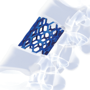 NESTLE Titanium Mesh System