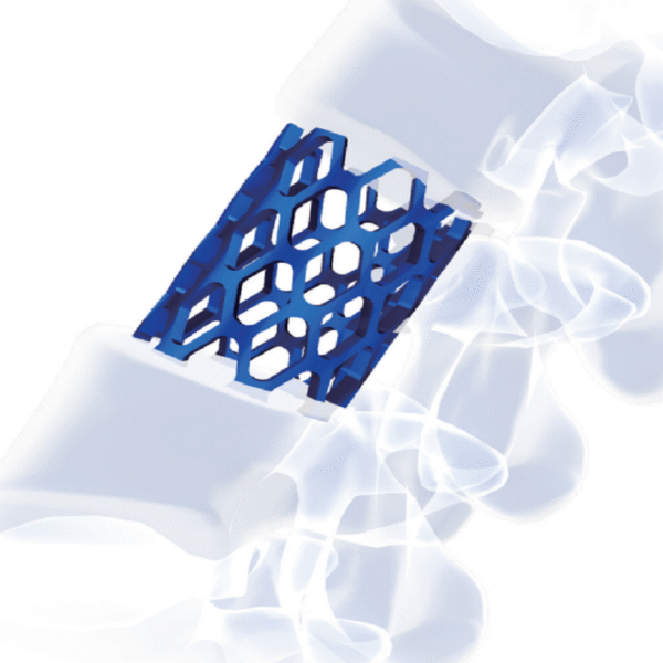 NESTLE Titanium Mesh System