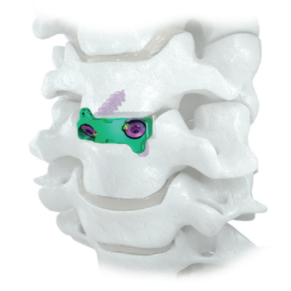 COLUMB  Zero-Profile Cervical Interbody Fusion System