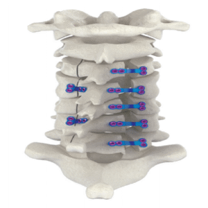 ZIPPER Posterior Cervical Laminoplasty Internal Fixation System