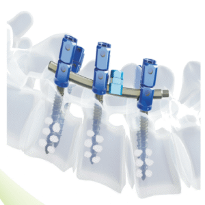 FORTRESS  Bone Cement Injectable Canulated Pedicle Screw